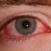 czerwone oko leczenie